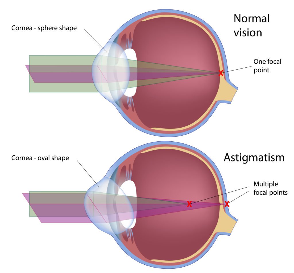 Eyeglasses for Astigmatism - Visions of Canada